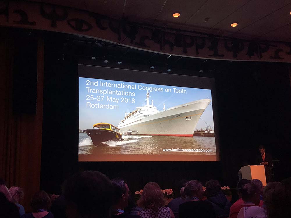 Autotransplantatie-OrthodontistMatthewWiranto-OrthodontiepraktijkAlmelo