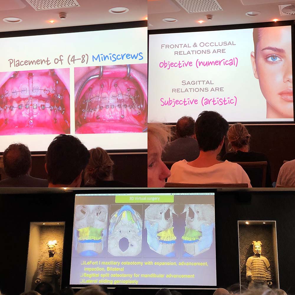 Surgery-First-Matthew-Wiranto-Orthodontiepraktijk-Almelo