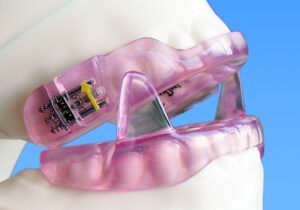 Anti Snurk Beugel MRA Orthodontiepraktijk Almelo Anti Snurk Beugel MRA Orthodontiepraktijk Almelo
